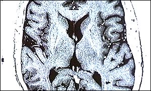 Brain image