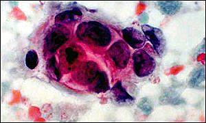 Cancer cell