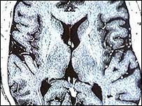 Brain