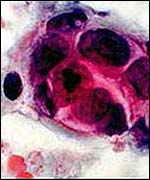 Breast cancer cells