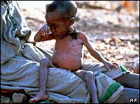 कुपोषण का शिकार बच्चा