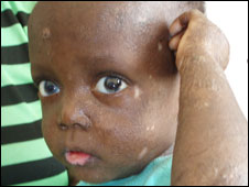 A child survivor in Northern Ghana