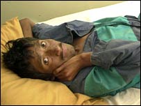 एड्स रोगी