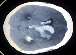 Scan showing an intracerebral and intraventriclar haemorrhage