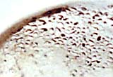 Detail of the anaemic lesions in the eye sockets