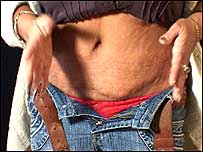 Botched stomach after surgery