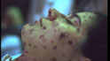 Smallpox Sufferer