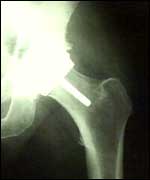 X-ray of a hip