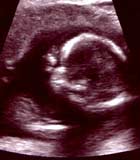 Ultrasound picture of a female foetus aged 16 weeks