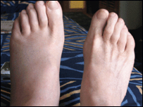 Ouch - John's foot is hurting