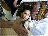 Ali Abbas, Iraqi limbless boy