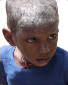 Many families in Kali blame the broken asbestos for skin irritations their children suffer