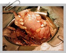 Kidney surgery