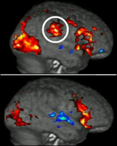 The ringed area shows the pain centres responding in the brain of the top subject