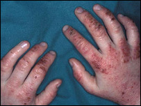 Paciente com eczema